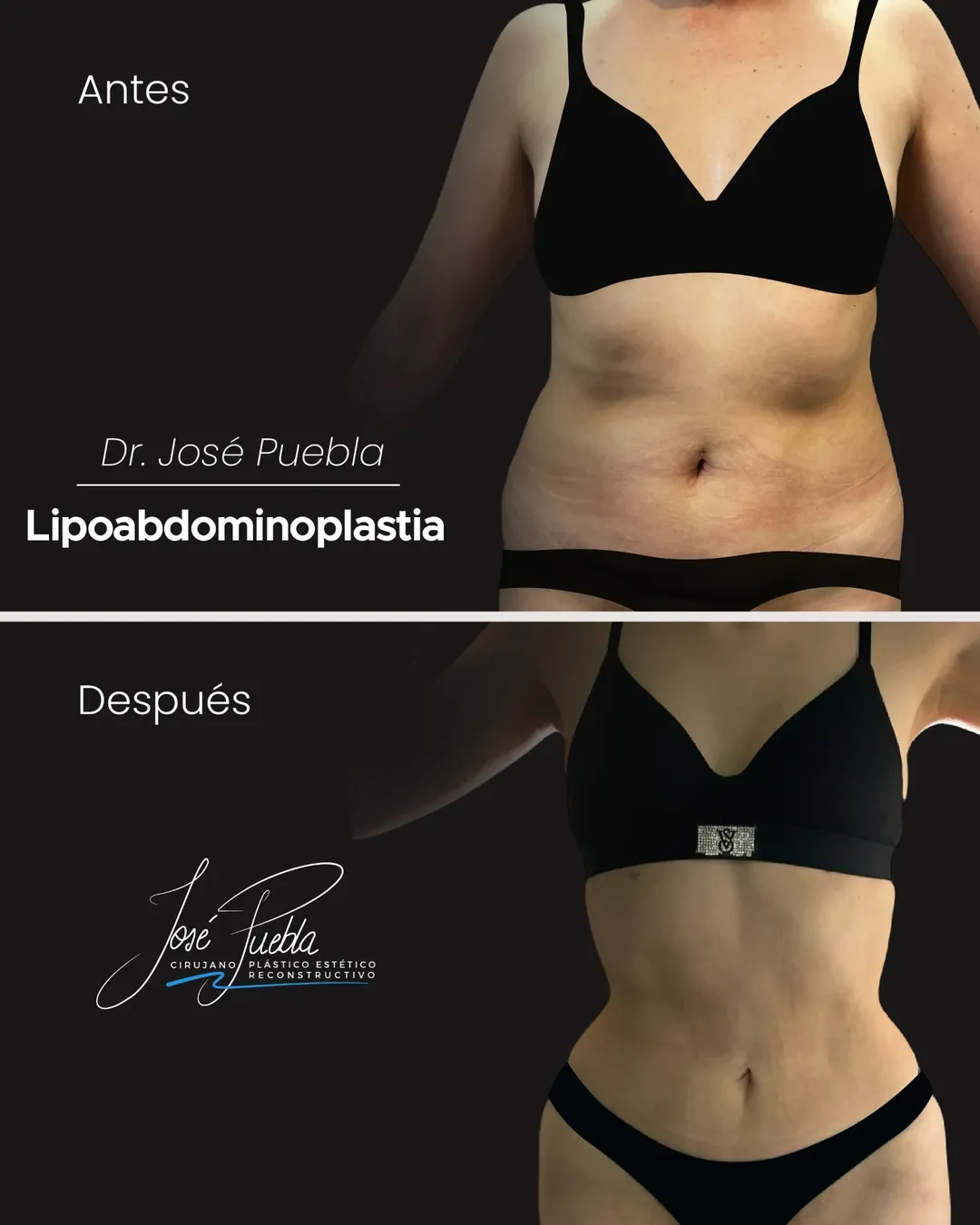 Antes y después Lipoabdominoplastia
