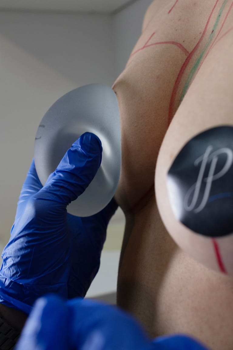 Aumento de senos con implantes y/o grasa: guía clara y honesta