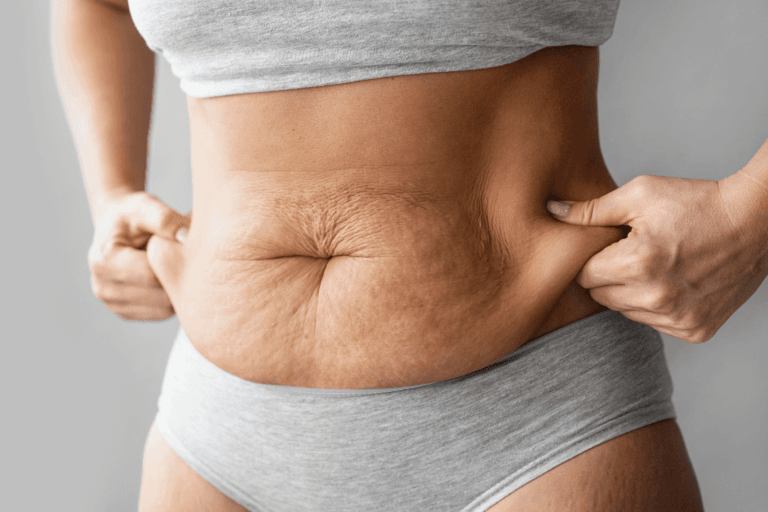 Abdominoplastia: El fin de la flacidez abdominal y la piel sobrante
