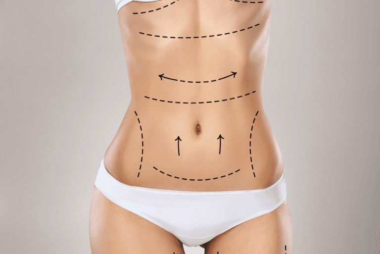 Lipoescultura 360: Mi Enfoque para Lograr tu Contorno Corporal Definitivo